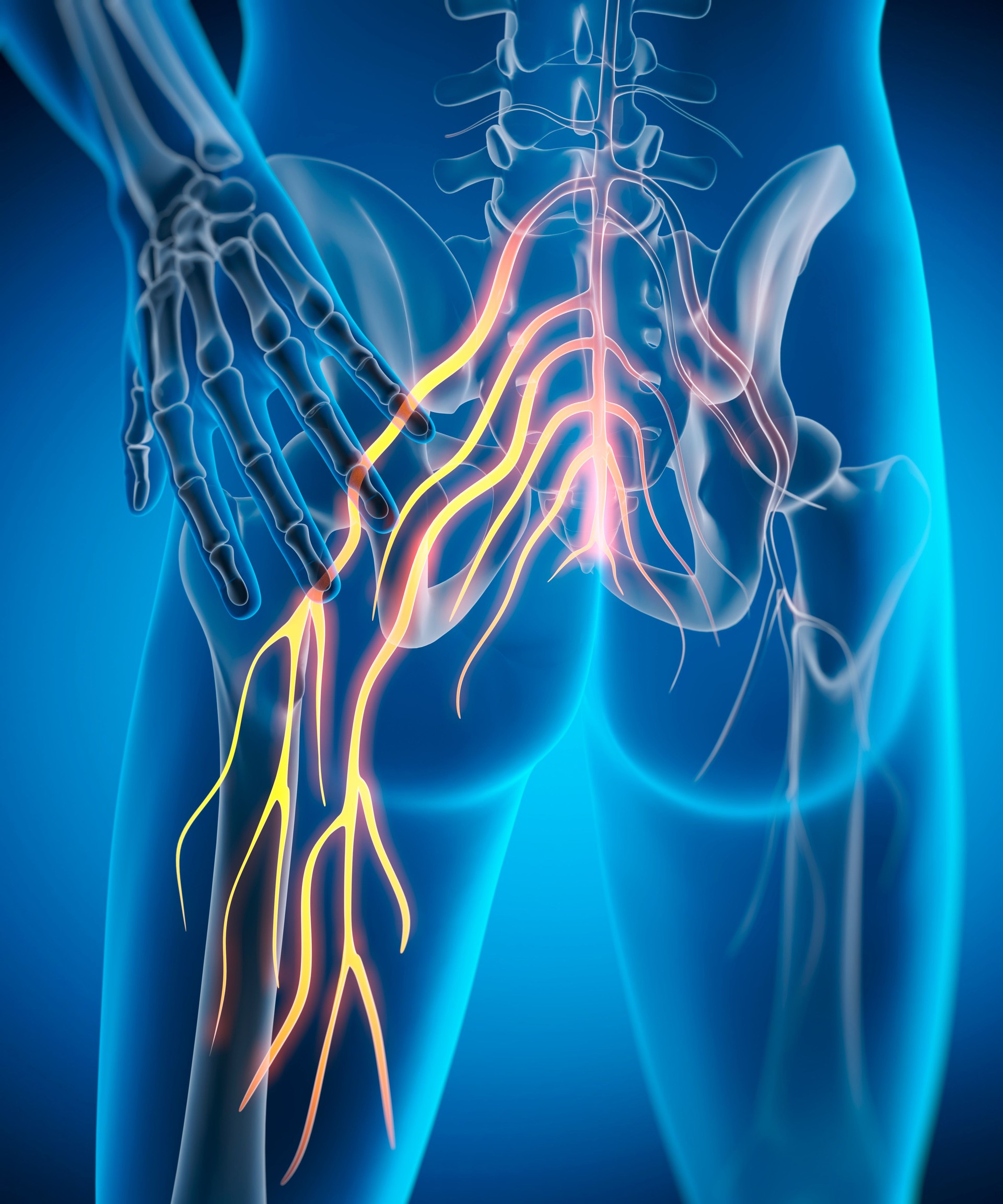 Sciatica - nerve pain injury or irritation sciatic nerve